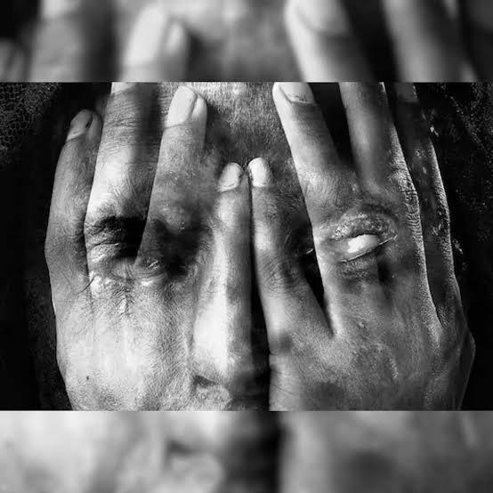 Girl injured in acid attack in Shopian, shifted to Srinagar hospital