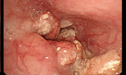 Dr Mir Samiullah performs complex surgery for cancer of esophagus