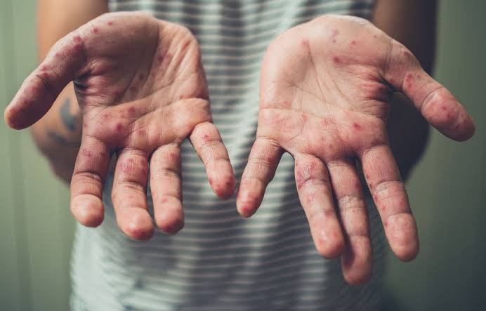 HFMD outbreak: Ready to tackle any situation, says Director Health